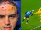 Atalantan Nikola Krstović n&auml;ytt&auml;&auml; otsaansa dramaattisen viime hetken rangaistuksen j&auml;lkeen BVB:t&auml; vastaan