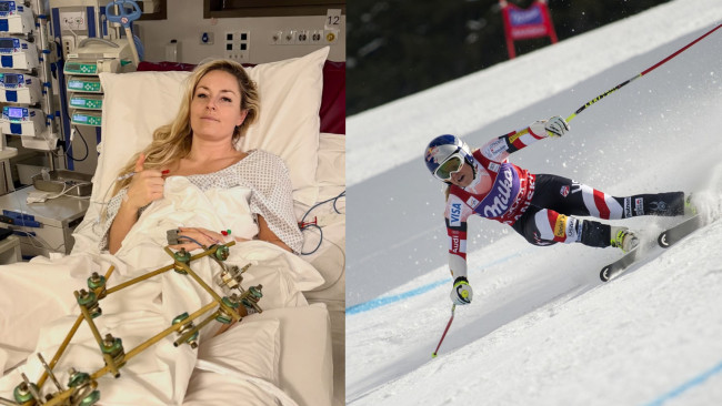 Amerikkalainen hiihtäjä Lindsey Vonn joutuu kolmanteen leikkaukseen jalkansa takia